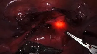 Isthmocele: Hysteroscopic transillumination to find boundaries