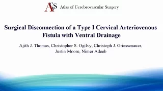 Surgical Disconnection of a Type I Cervical Arteriovenous Fistula with Ventral Drainage