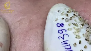 Blackheads extraction and pimple popping (398) | Loan Nguyen