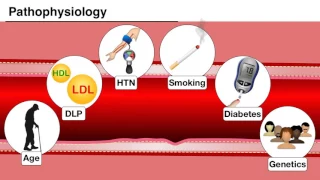 Ischemia 1/7 - Introduction and pathophysiology of ACS