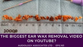 THE BIGGEST EAR WAX REMOVAL VIDEO ON YOUTUBE? - EP163