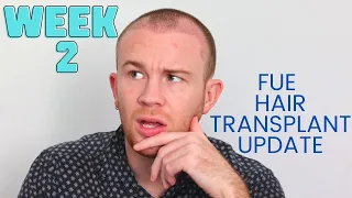 Week 2 FUE Hair Transplant RESULTS/HEALING/RECOVERY