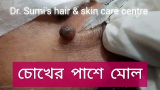 Mole | মুখের ছোট ছোট তিল, মোল ও আচিঁল দুর করার উপায় |তিল ও আচিঁলের আধুনিক চিকিৎসা |Removal of Mole |