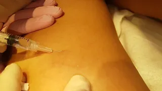 LIQUID SCLEROTHERAPY - SPIDER VEINS.mp4