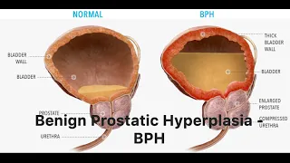 Benign Prostatic Hyperplasia - BPH