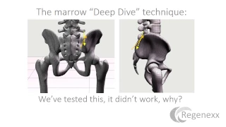 Maximizing Stem Cell Yield from a Bone Marrow Aspiration