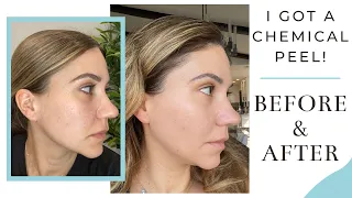 VI Peel - Crazy Before & After Results