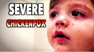 SEVERE CHICKENPOX! | Dr. Paul