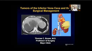Tumors of the Inferior Vena Cava and their Surgical Management