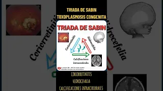 Triada de Sabin / Toxoplasmosis congénita #medicine #triadas #toxoplasmosis