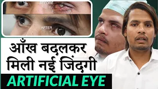 नकली आँख से मिली नई जिंदगी | Artificial Eye | Prosthetic Eye | Artificial Scleral Eye Shell