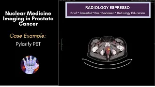 NUCLEAR MEDICINE IMAGING IN PROSTATE CANCER: Case Example – Pylarify PET Scan (5560)
