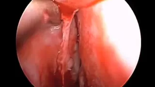 Deviated Nasal Septum Repair: Endoscopic Septoplasty in HD