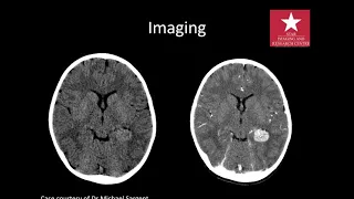 imaging of Intraventricular tumours