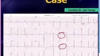 Mattu EKG Vakası: 1 Temmuz 2013 (Türkçe Altyazılı)