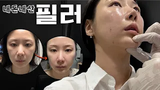 눈밑고랑, 팔자, 인디언주름을 한방에 해결한 필러시술법💡 상담부터 시술과정 전후사진까지 (대받녀) l 소의튜브soytube