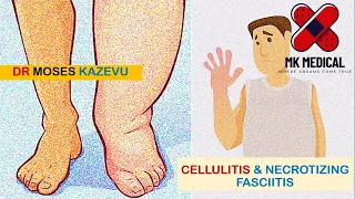 Cellulitis || Necrotizing Fasciitis