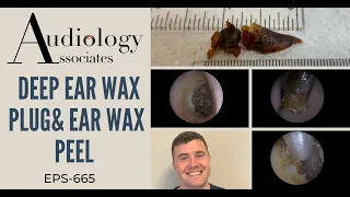 DEEP EAR WAX PLUG & EAR WAX PEEL - EP665