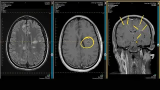 ADC Positive Multiple Sclerosis - Demyelination MRI Case Review