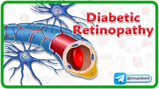 Diabetic Retinopathy Animation : Pathogenesis, Classification, Diagnosis, Treatment & Complications