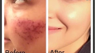 Microneedling Skin Update| Before & After| Worth the Money?