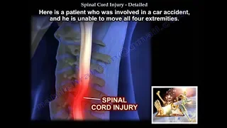 Spinal Cord Injury, Detailed  - Everything You Need To Know - Dr. Nabil Ebraheim