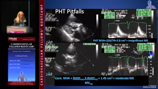 Mitral Stenosis (Karla Kurrelmeyer, MD)