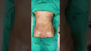 360 Abdominal Liposuction #cosmeticsurgery #drprashantyadav #shortvideo