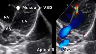 Types of VSD echocardiography