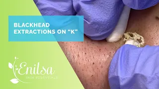 Blackhead & Whitehead Extractions on K