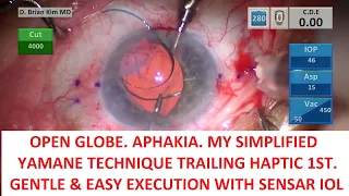 Open Globe. My Simplified Yamane Trailing Haptic 1st Sensar IOL. Single Pass 4 Throw Pupilloplasty