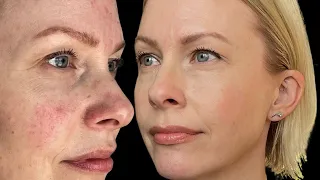 HOW I FIXED my rosacea ‼