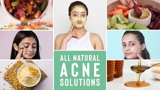 Causes & Ways To Treat Acne In Humid Weather Conditions | Home Remedies | Humid Weather Series Ep 4