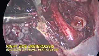 Laparoscopic pelvic ureterolysis