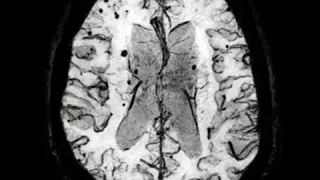 SWI in CAA(cerebral Amyloid Angiopathy)