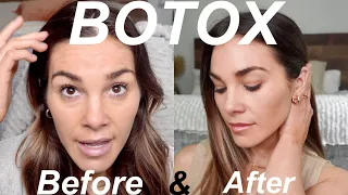 MY BOTOX EXPERIENCE | Before & After | Pricing, Units, Results