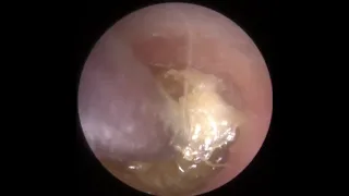 879 - Pushed In Ear Wax Removal