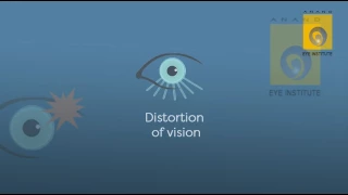 keratoconus