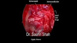 Endoscopic skull base surgery with optic nerve decompression & CSF leak repair
