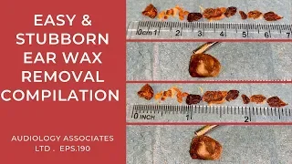 EASY & STUBBORN EAR WAX REMOVAL COMPILATION - EP 190