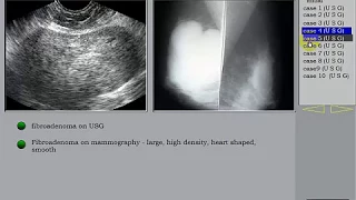 Breast Ultrasound Part 2 Fibroadenoma