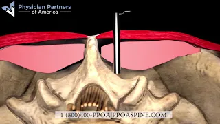 Minimally invasive laser discectomy - PPOA
