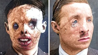 The Tragic History Of WW1 And Plastic Surgery