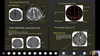 Supratentorial anatomy