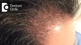 What are the post surgical instructions for Hair Transplant? - Dr. K Prapanna Arya
