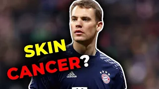 Manuel Neuer had Battled SKIN CANCER 😔😢