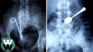 15 Craziest Things Swallowed By People