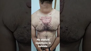 say no to steroid injections in keloids #keloidtreatment