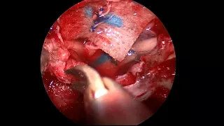 Endoscopic Endonasal Approach to the Optic Canal