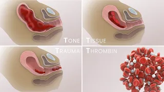 Management of Postpartum Hemorrhage (PPH) | Etiologies, prevention, treatment | TVASurg